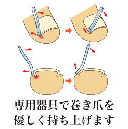 福岡市の東区巻き爪センター